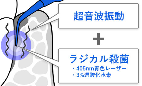 ブルーラジカル治療